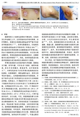 中国烧伤创疡杂志2025年5月第3期